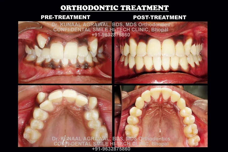 braces before and after bhopal 11